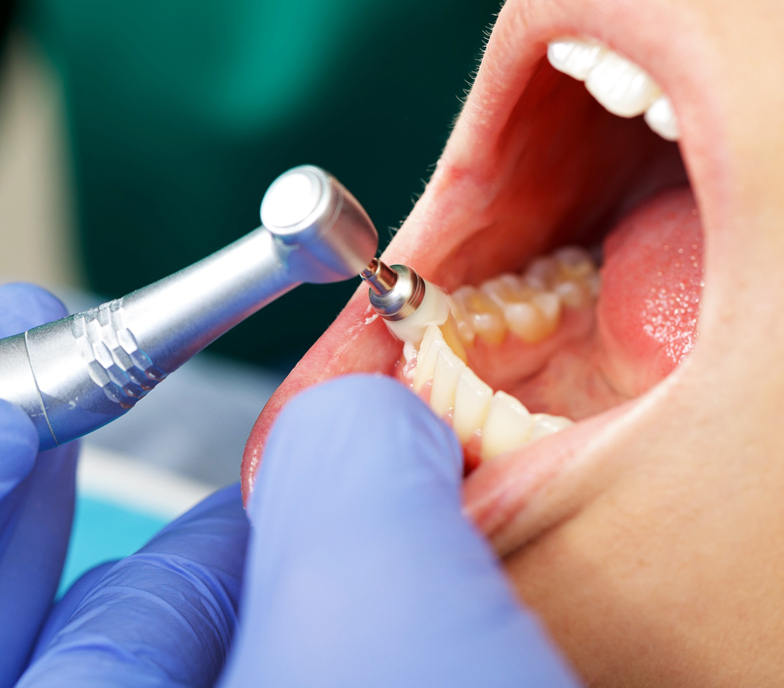 予防・クリーニング