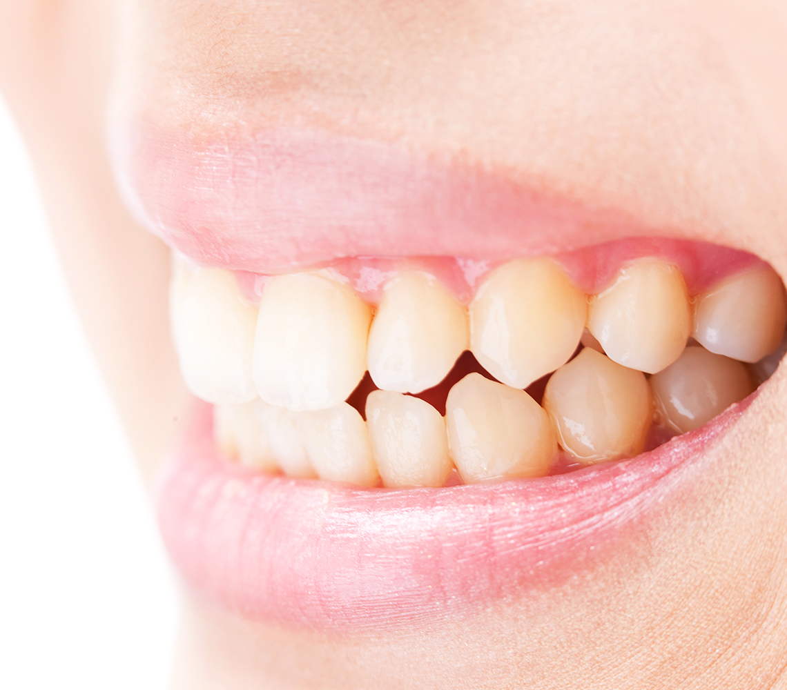 歯ぎしり・食いしばり