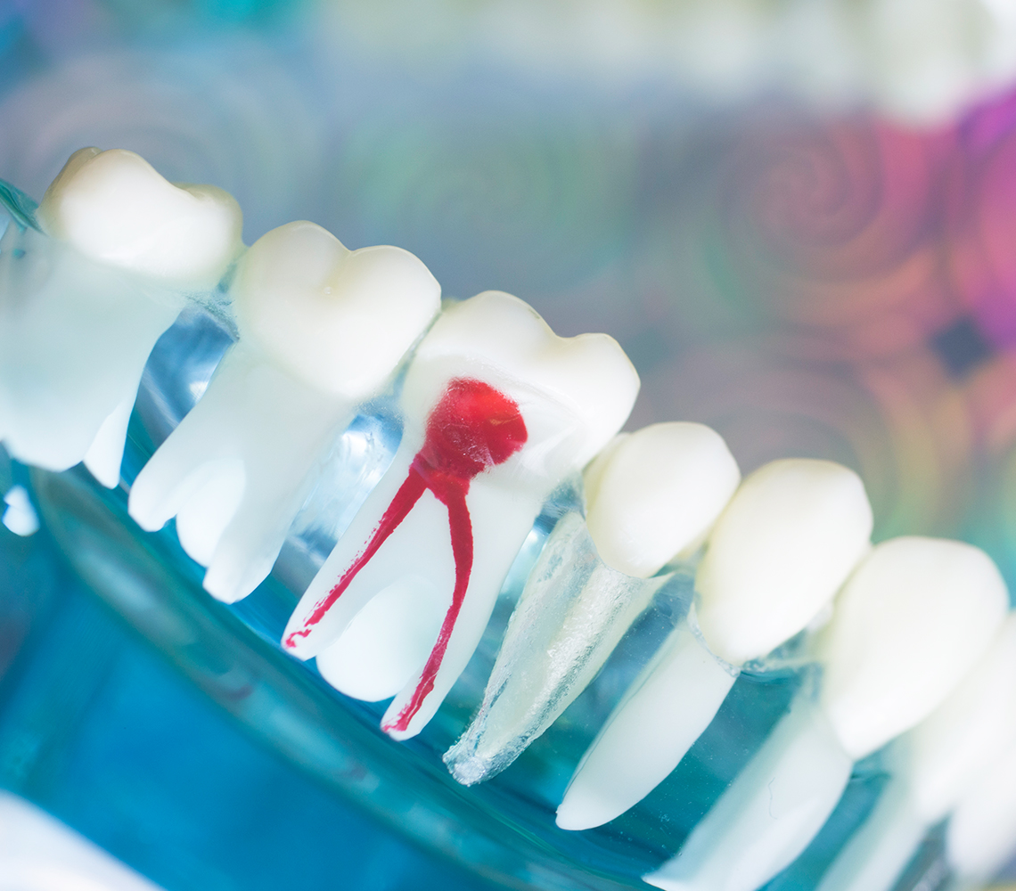 根管治療（歯内療法）